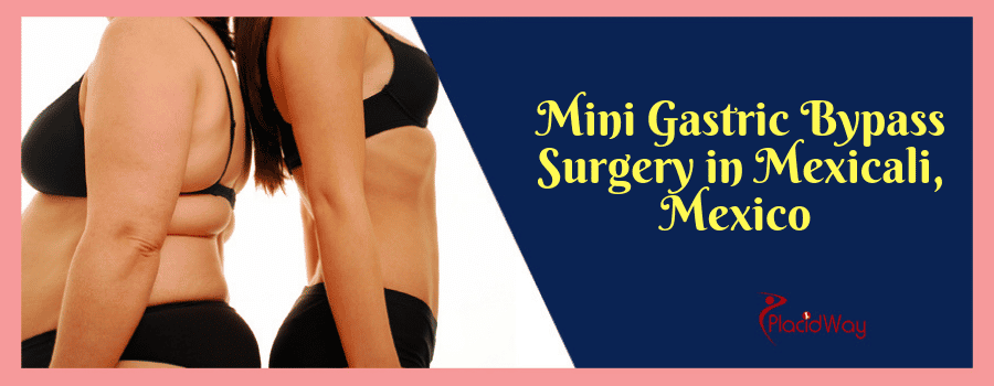 Mini Gastric Bypass Surgery in Mexicali, Mexico 